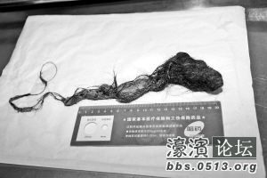 10岁<em>女童</em>得怪癖吃8年头发 胃被头发石<em>霸占</em>了