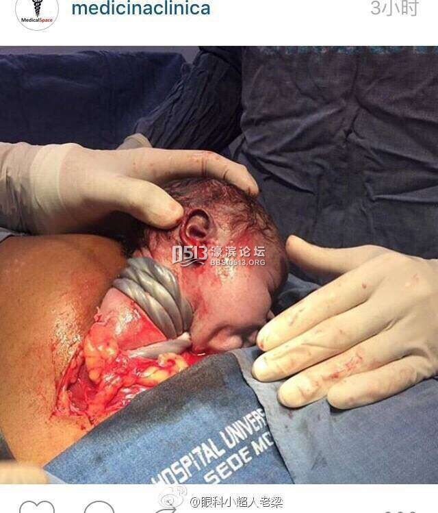 剖腹产脐带绕颈的小孩照片,看看都疼啊
