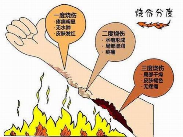 儿童烫伤,划伤,扭伤,流鼻血的急救处理误区