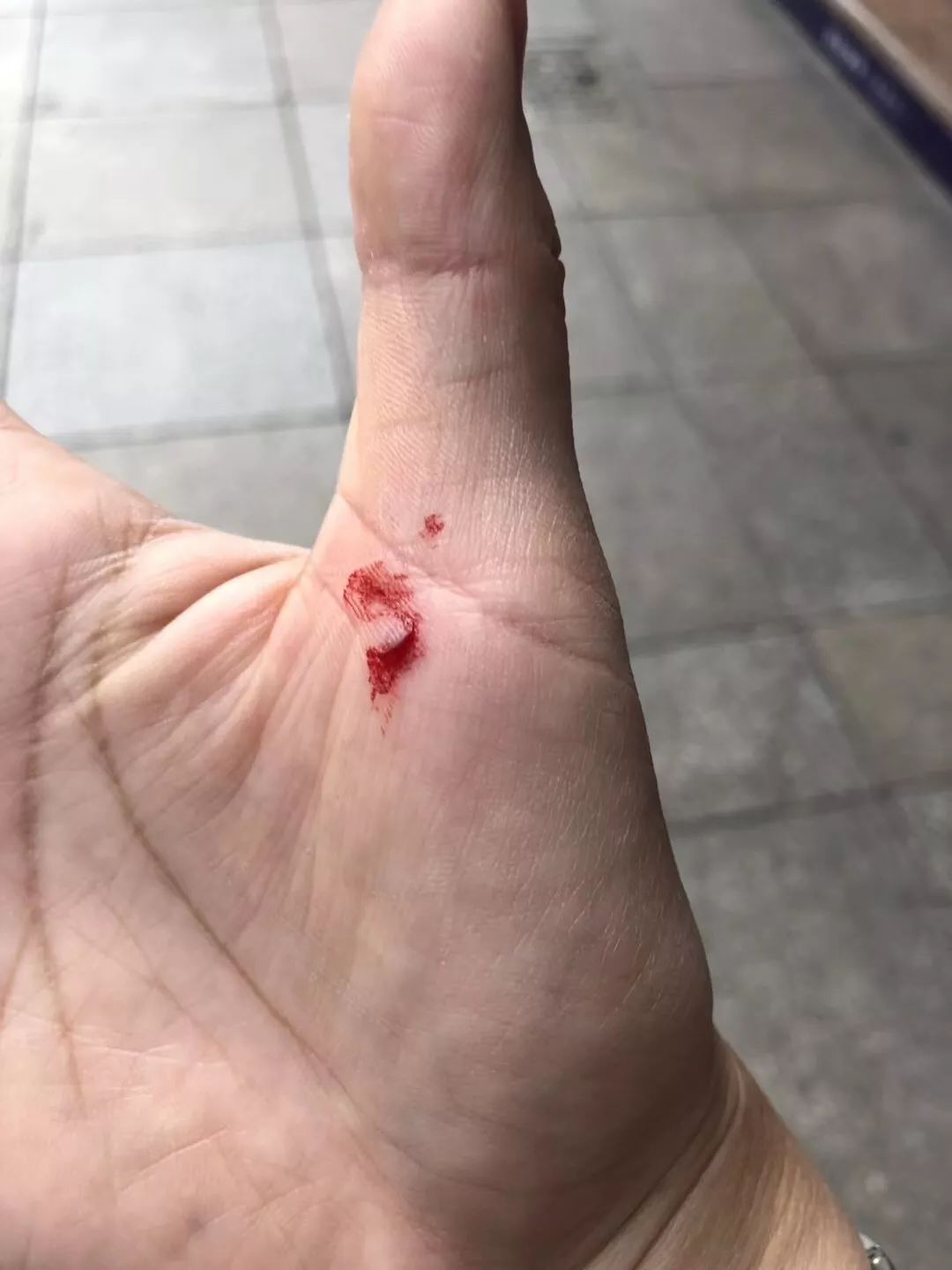 凌女士的手在推搡的时候受了伤.