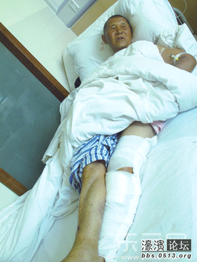老人腿部骨折住院图片图片