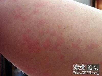 濠滨健康网过敏