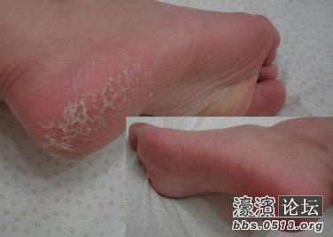 脚后跟开裂
