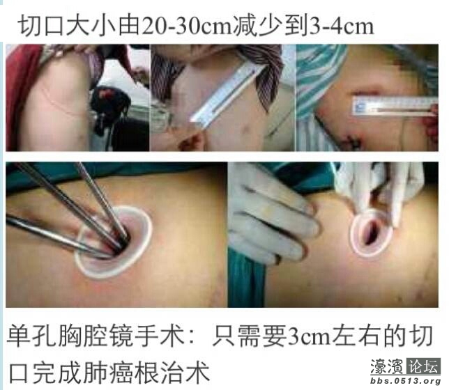 单孔胸腔镜手术