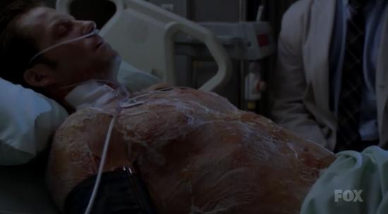 豪斯805：恐怖的蜕皮病（剧透/重口，慎入）