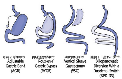 四种手术示意图。图片信息：win.niddk.nih.gov 。
