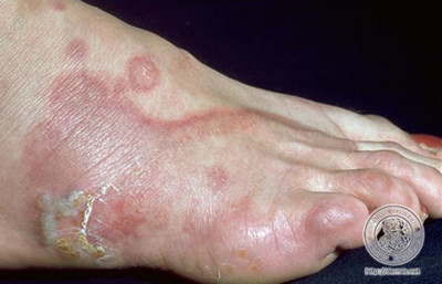 典型足癣（水疱鳞屑型）图片来自：http://dermis.net/dermisroot/en/15724/image.htm