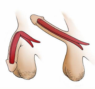 简单的无需充入液体的假体。 图片来自 www.riversideonline.com