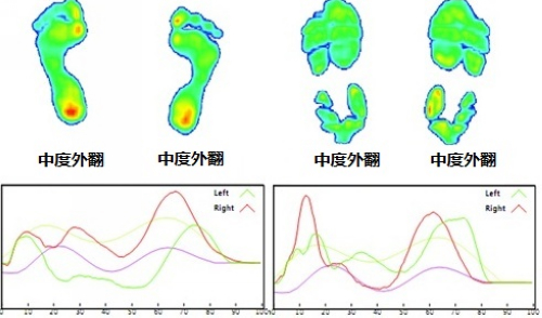 脚型为中度外翻的长跑者（左图）穿上爱斯克斯抗外翻鞋后，外翻没有得到矫正（右图），计算后判断，仍然中度外翻。