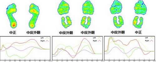 左脚中正的长跑者（左图）穿上美津浓普通型鞋，变成中度外翻（中图），跑过100公里，后脚跟外翻变得非常明显（右图）。
