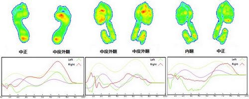 左脚中正的长跑者（左图）穿上李宁普通型鞋，变成中度外翻（中图），跑过100公里，鞋底外侧塌陷，导致内翻（右图）。