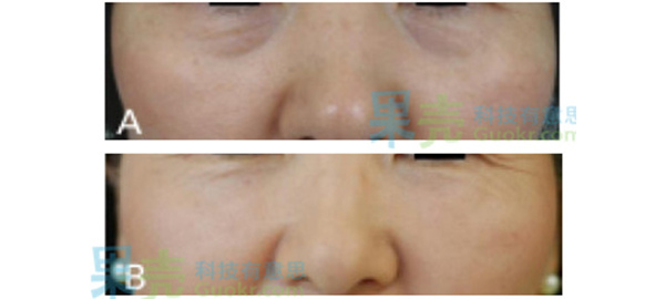 衰老松弛造成的阴影型黑眼圈。A）眼袋造成了明显的阴影   B）自体脂肪移植后效果良好