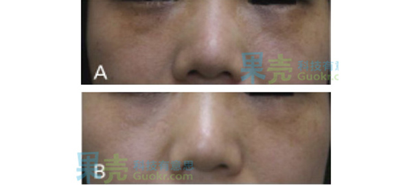 真皮黑素细胞增多造成的色素型黑眼圈。A）治疗前   B）Q开关翠绿宝石激光治疗后