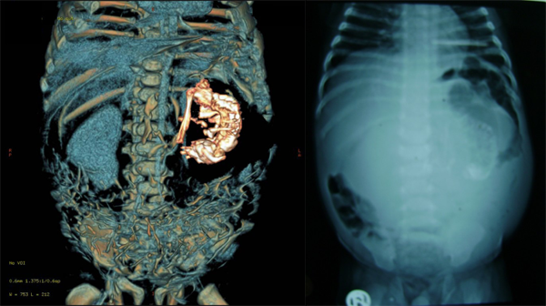 印度一名2岁1个月的幼儿（男），体内存在内寄生胎，此为其腹部CT及X光检查结果。左图：64层螺旋CT扫描出寄生胎的骨骼（右部白色部分）。右图：腹平片，左腹有纵向钙化带。图片来自：http://www.ncbi.nlm.nih.gov/pmc/articles/PMC2852393/。