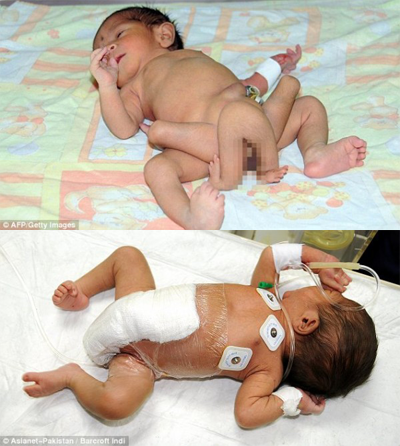 巴基斯坦一夫妇（同时也是堂兄妹）的儿子出生时有6条腿，这名男婴多出的4条腿即为外寄生胎。幸运的是这名男婴其它方面一切正常，医生们手术切除了他多余的4条腿。图片来自：http://www.dailymail.co.uk/health/article-2132122/Six-legged-baby-born-Pakistan-Doctors-successfully-remove-limbs.html?ITO=1490。