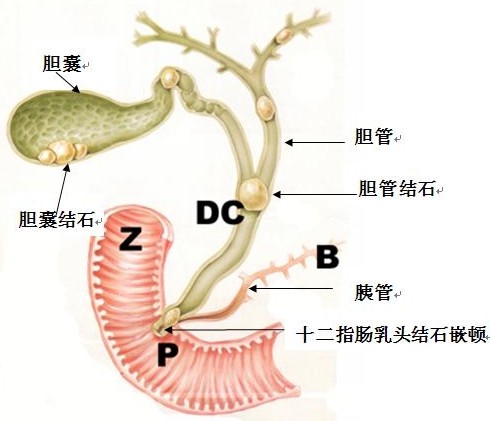 喝果汁和植物油能排出胆结石吗？