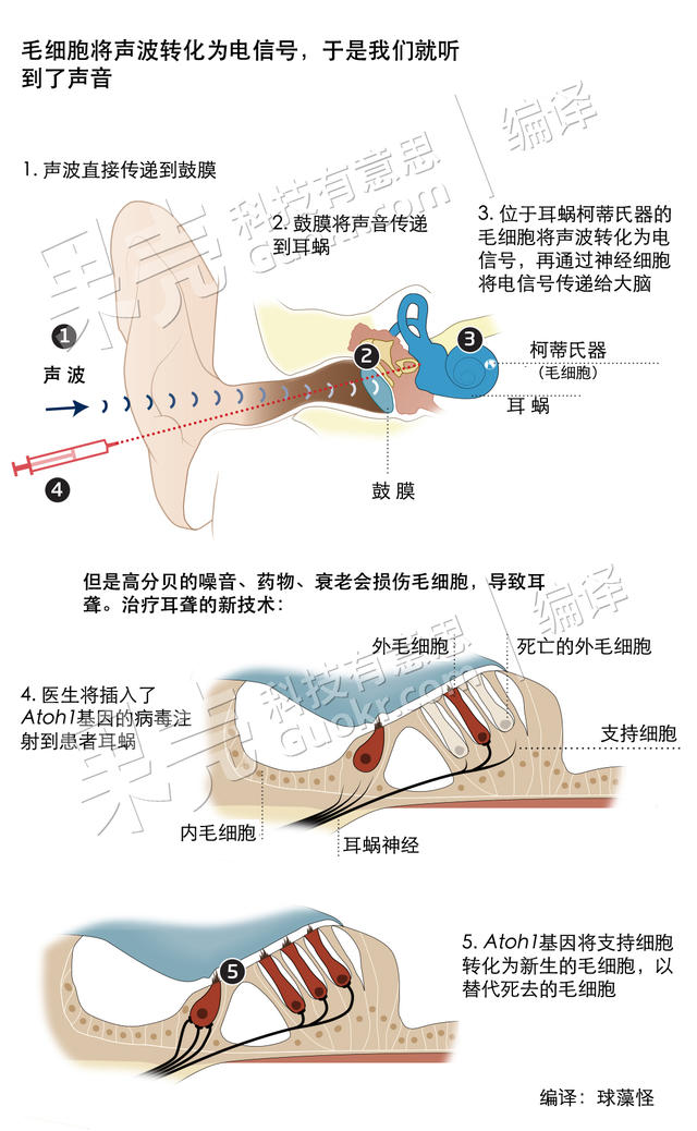 基因疗法，失聪者的福音