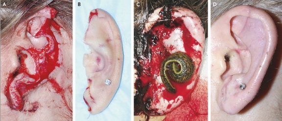 医疗水蛭：吸你的血，治你的病