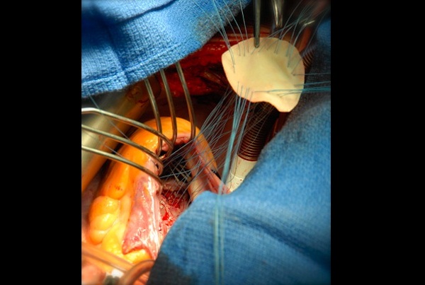 心室间隔缺损修复手术，医生正在用来源于牛的补片修补患者心脏上明显可见的洞口。（作者：HENRY DE’ATH, ROYAL LONDON HOSPITAL）