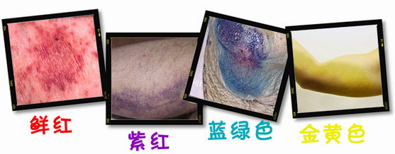 淤青的4种颜色，图片为作者自制。