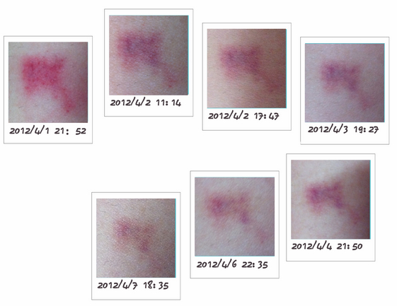 吻痕的7天变化，图片为作者提供。