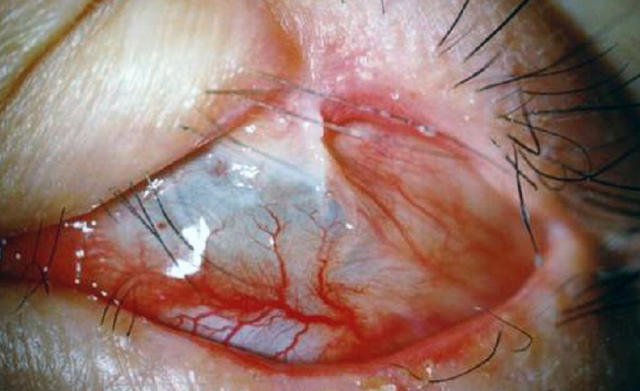 【春节怎么办】眼科医生忠告：春节放炮，别让眼睛受伤