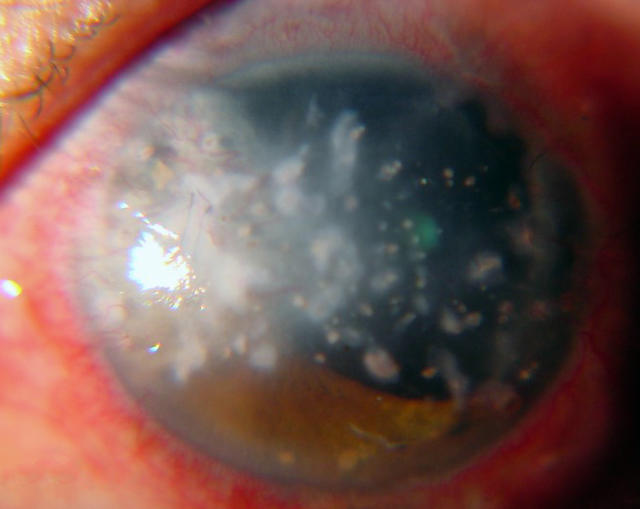 【春节怎么办】眼科医生忠告：春节放炮，别让眼睛受伤