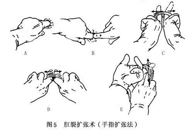【世界杯专辑】刚烈的肛裂！如何避免马斯切拉诺和夏侯惇的惨剧？