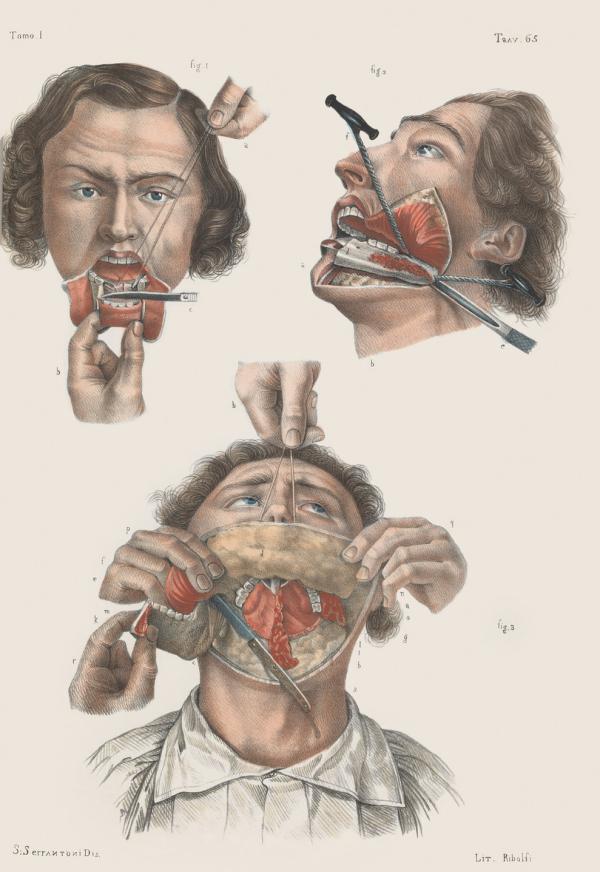 这些19世纪的外科手术图画，会不会让你庆幸自己活在现代？