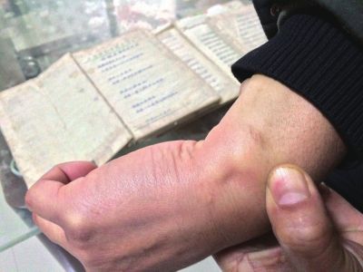 高炎龙右手手腕上有伤疤，他称这是遭警方刑讯逼供留下的。