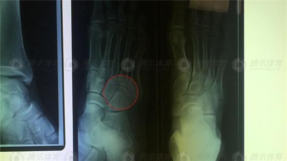 孙杨澳洲集训受重伤右脚跖骨骨折，估计6周才能痊愈