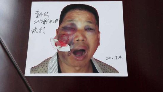 岳阳一当事人称被法官咬穿面部致毁容