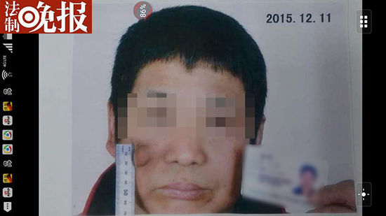 岳阳一当事人称被法官咬穿面部致毁容