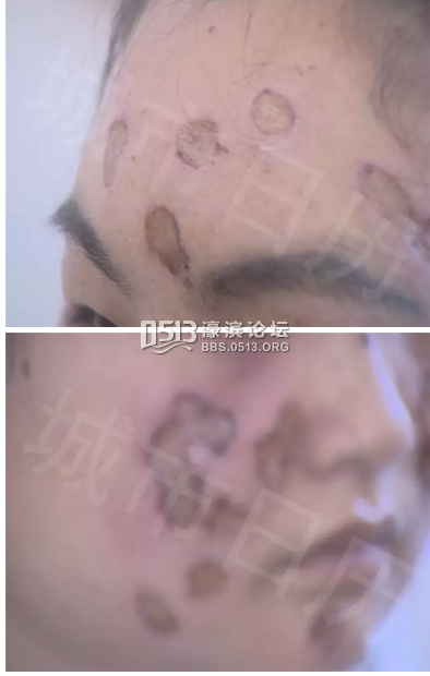 有的人为什么要烫烟疤 203026avsfl1t595d7h8t1.png