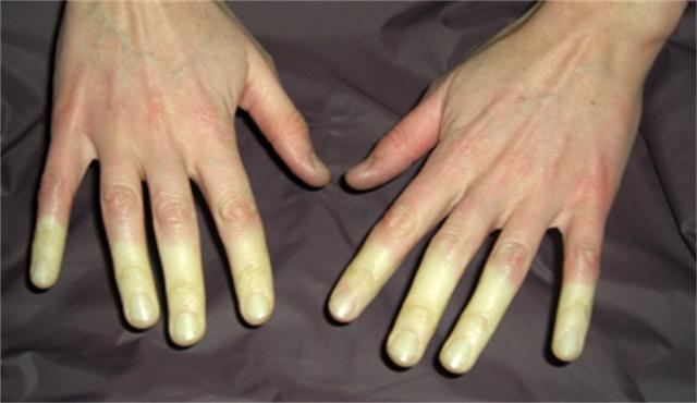 一到冬天就“血流不畅”？微循环障碍可不是这么回事