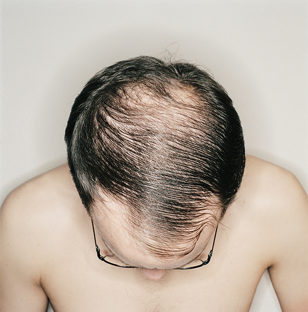 年轻人秃发越来越多，心病还须心药医