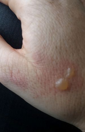 北京飞墨尔本航班发生耳机爆炸：女乘客面部灼伤，炸因在电池