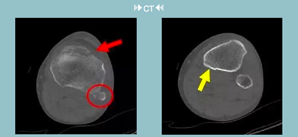 放射科医生：骨折为什么做完X光检查又要做CT