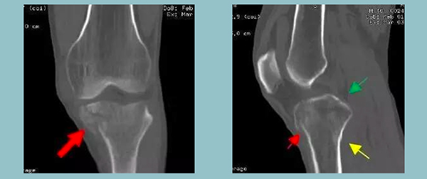 放射科医生：骨折为什么做完X光检查又要做CT