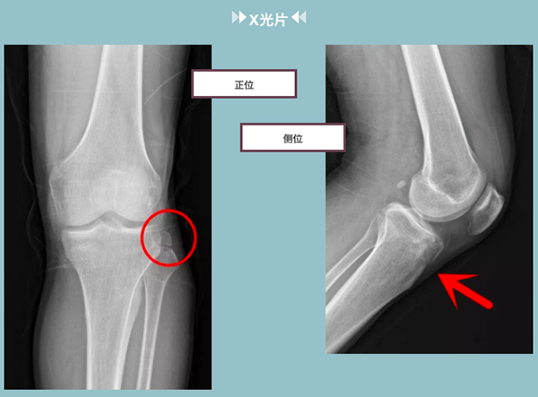 放射科医生：骨折为什么做完X光检查又要做CT