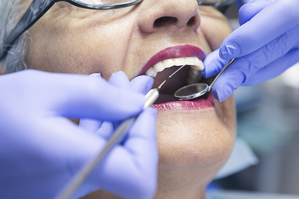 美国研究：老年女性患牙龈疾病，过早死亡风险增12%