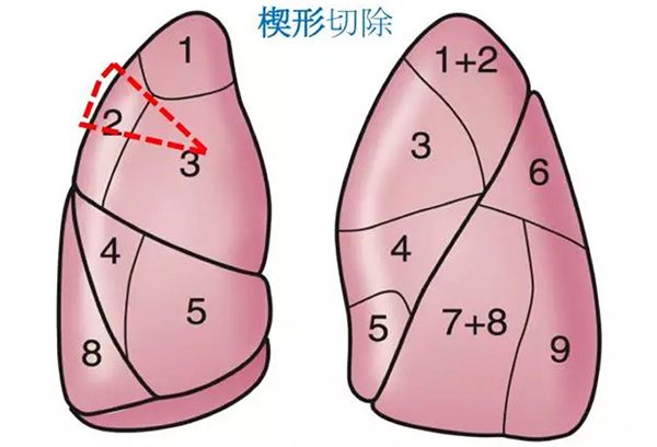 肺部小结节如何处理，须解开“三大纠结”