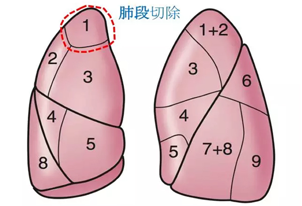 肺部小结节如何处理，须解开“三大纠结”