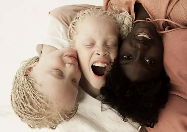 拍摄白化病姐妹花的摄影师：每个人都有自己的独特之美