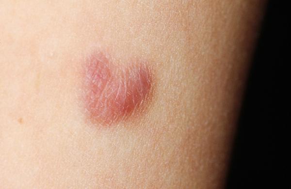 子宫肌瘤可不开刀，HIFU超声无创治疗