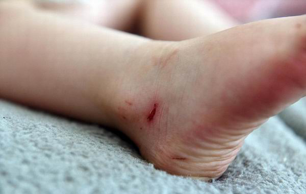 两岁女孩穿NEXT凉鞋半小时满脚血印，家长要求品牌召回