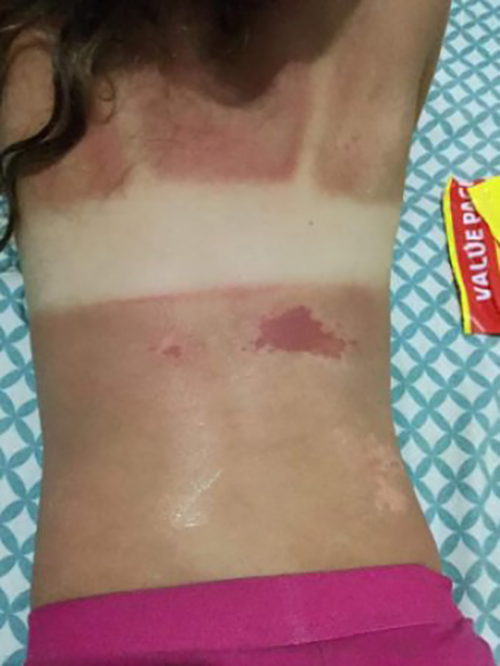 14月女童因香蕉船防晒霜受伤害，儿童防晒谨防“雷区”