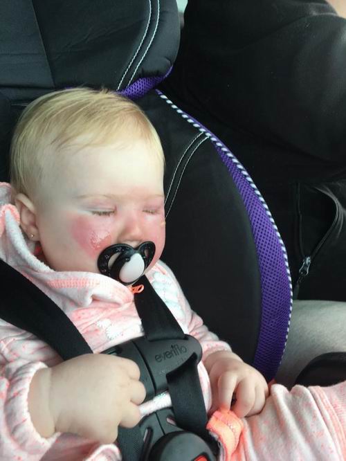 14月女童因香蕉船防晒霜受伤害，儿童防晒谨防“雷区”