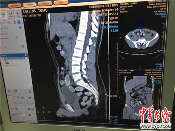 上海海关查获人体藏匿走私毒品案，非洲男子腹内藏30圆柱体