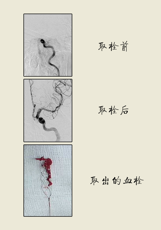 漫画｜脑血栓能取出来？抓紧中风后六小时